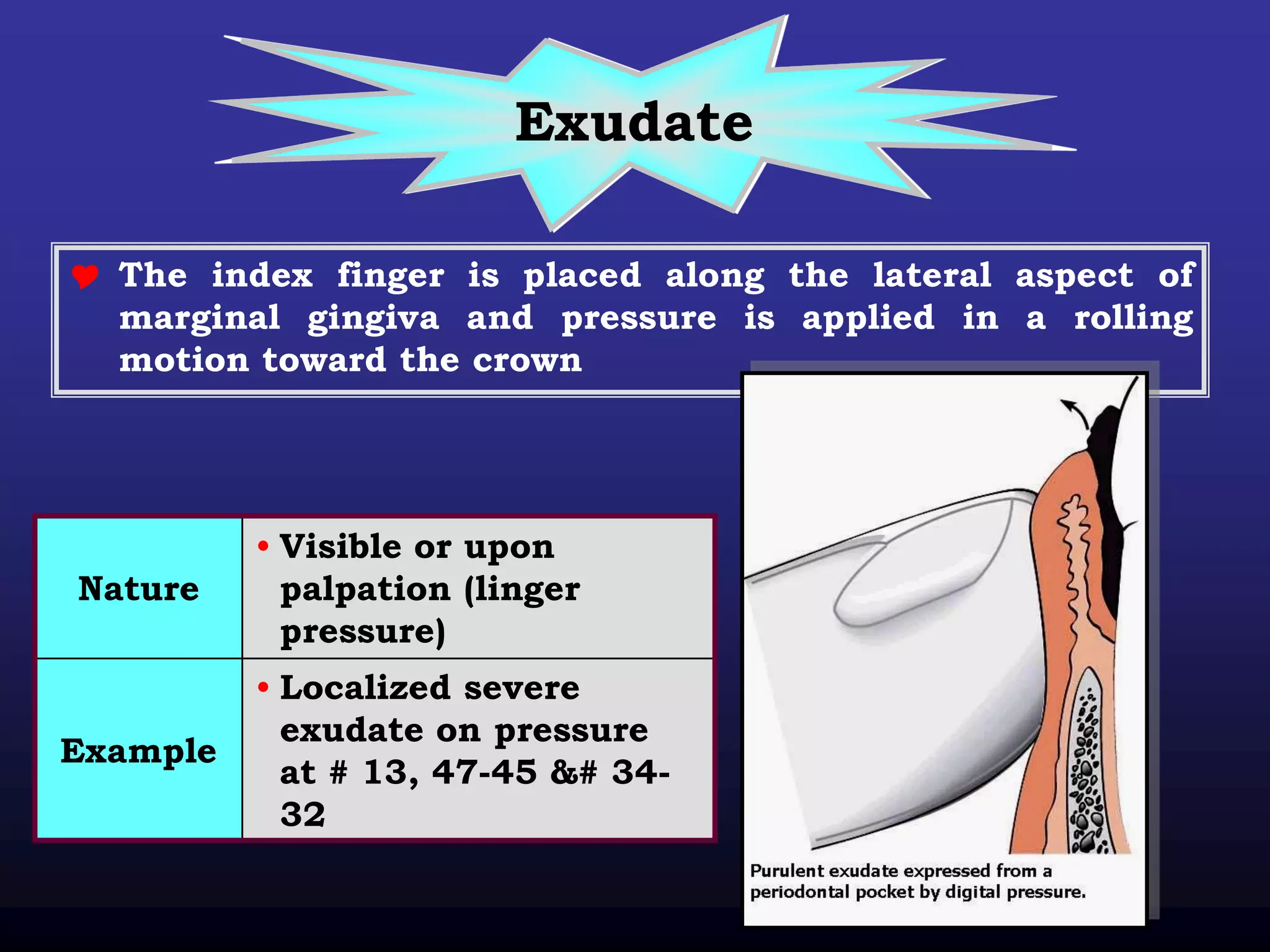 Exudate

 The index finger is placed along the lateral aspect of
  marginal gingiva and pressure is applied in a rolling
  motion toward the crown




          • Visible or upon
Nature      palpation (linger
            pressure)
          • Localized severe
            exudate on pressure
Example
            at # 13, 47-45 &# 34-
            32
 