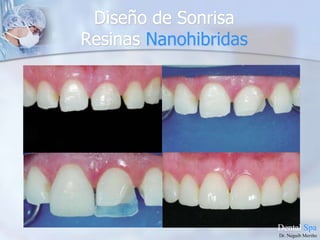 Prótesis fijas Libres De Metal.