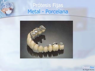 Prótesis removibles Parciales y totales Flexibles.