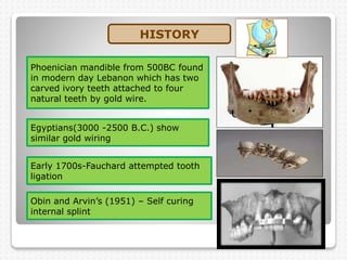 HISTORY
Phoenician mandible from 500BC found
in modern day Lebanon which has two
carved ivory teeth attached to four
natural teeth by gold wire.
Obin and Arvin’s (1951) – Self curing
internal splint
Egyptians(3000 -2500 B.C.) show
similar gold wiring
Early 1700s-Fauchard attempted tooth
ligation
 