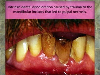 Intrinsic dental discoloration caused by trauma to the mandibular incisors that led to pulpal necrosis. 