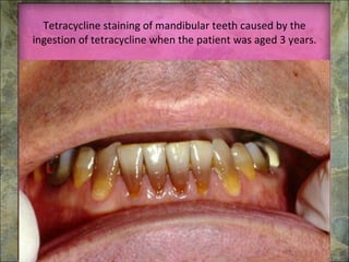 Tetracycline staining of mandibular teeth caused by the ingestion of tetracycline when the patient was aged 3 years. 