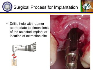 Surgical Process for Implantation
• Drill a hole with reamer
appropriate to dimensions
of the selected implant at
location of extraction site
 