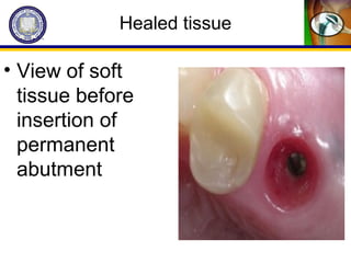 Healed tissue
• View of soft
tissue before
insertion of
permanent
abutment
 