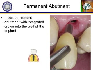 Permanent Abutment
• Insert permanent
abutment with integrated
crown into the well of the
implant
 
