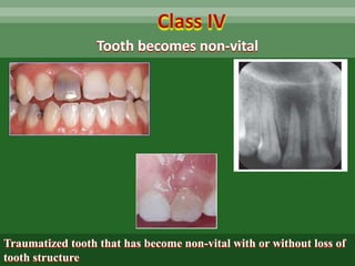 Tooth becomes non-vital
Class IV
Traumatized tooth that has become non-vital with or without loss of
tooth structure
 