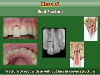 Class VI
Fracture of root with or without loss of crown structure
Root Fracture
 