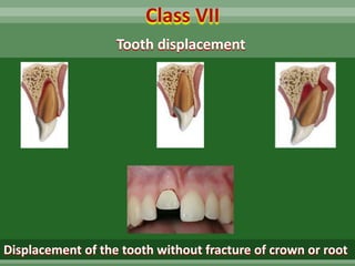 Tooth displacement
Class VII
Displacement of the tooth without fracture of crown or root
 