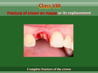 Fracture of crown en masse or its replacement
Class VIII
Complete fracture of the crown
 