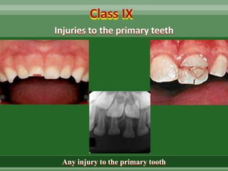 Class IX
Injuries to the primary teeth
Any injury to the primary tooth
 