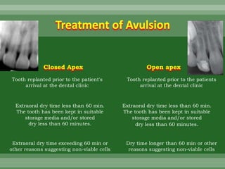 Treatment of Avulsion
Tooth replanted prior to the patient's
arrival at the dental clinic
Extraoral dry time less than 60 min.
The tooth has been kept in suitable
storage media and/or stored
dry less than 60 minutes.
Extraoral dry time exceeding 60 min or
other reasons suggesting non-viable cells
Tooth replanted prior to the patients
arrival at the dental clinic
Extraoral dry time less than 60 min.
The tooth has been kept in suitable
storage media and/or stored
dry less than 60 minutes.
Dry time longer than 60 min or other
reasons suggesting non-viable cells
Closed Apex Open apex
 