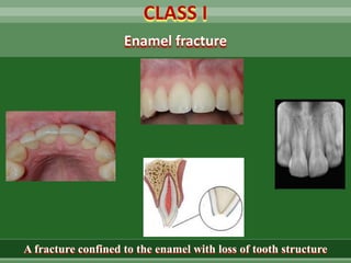 CLASS I
A fracture confined to the enamel with loss of tooth structure
Enamel fracture
 