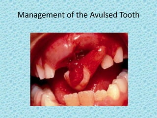 Management of the Avulsed Tooth
 