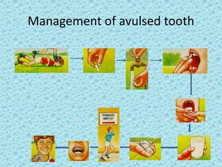 Tooth Avulsion Project Dental Trauma.ppt