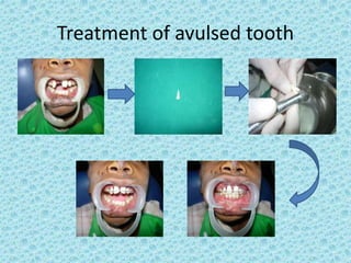 Tooth Avulsion Project Dental Trauma.ppt