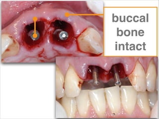 periodontal!
tissue
fracture of root at cervical
or deeper!
treatments:!
>> extract / implant / graft!
>> extract / graft!...