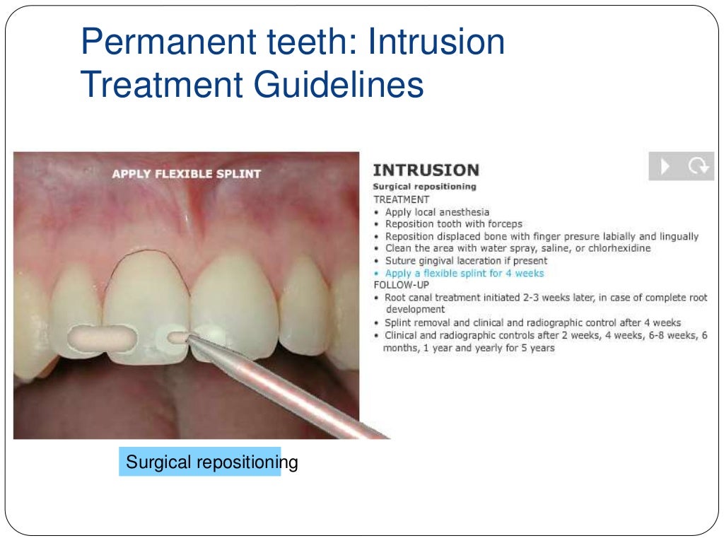 Dental trauma to permanent teeth