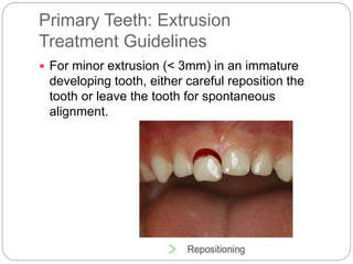 Primary Teeth: Extrusion
Treatment Guidelines
 For minor extrusion (< 3mm) in an immature
developing tooth, either careful reposition the
tooth or leave the tooth for spontaneous
alignment.
 