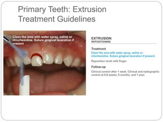 Primary Teeth: Extrusion
Treatment Guidelines
 
