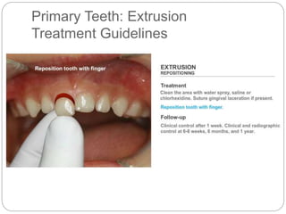 Primary Teeth: Extrusion
Treatment Guidelines
 