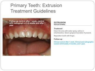 Primary Teeth: Extrusion
Treatment Guidelines
 