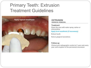 Primary Teeth: Extrusion
Treatment Guidelines
 