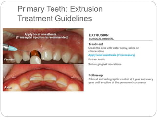 Primary Teeth: Extrusion
Treatment Guidelines
 