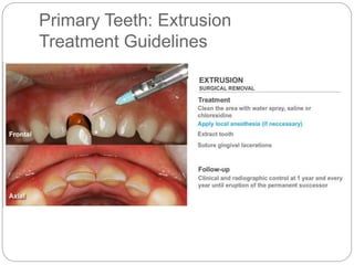 Primary Teeth: Extrusion
Treatment Guidelines
 