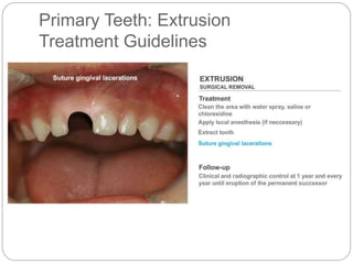 Primary Teeth: Extrusion
Treatment Guidelines
 