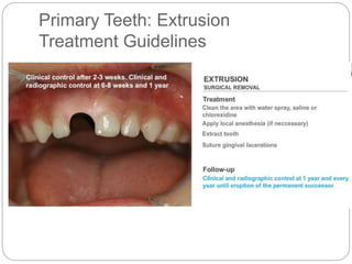 Primary Teeth: Extrusion
Treatment Guidelines
 