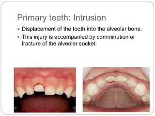 Primary teeth: Intrusion
 Displacement of the tooth into the alveolar bone.
 This injury is accompanied by comminution or
fracture of the alveolar socket.
 