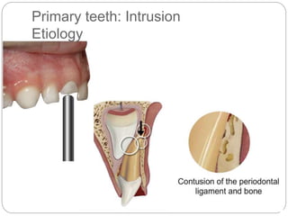 Primary teeth: Intrusion
Etiology
 
