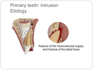Primary teeth: Intrusion
Etiology
 