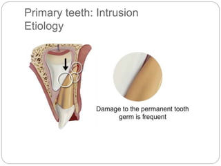 Primary teeth: Intrusion
Etiology
 