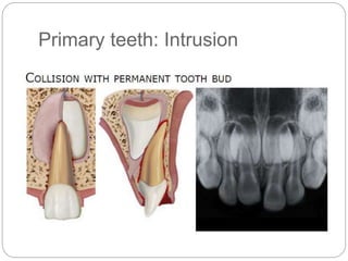 Primary teeth: Intrusion
 