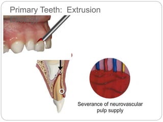 Primary Teeth: Extrusion
Etiology
 