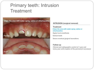 Primary teeth: Intrusion
Treatment
 