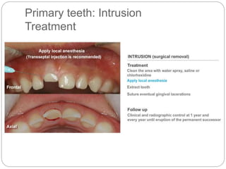 Primary teeth: Intrusion
Treatment
 