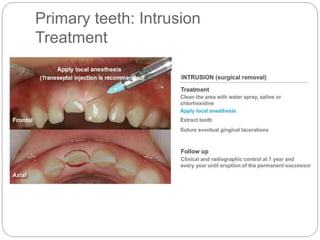 Primary teeth: Intrusion
Treatment
 