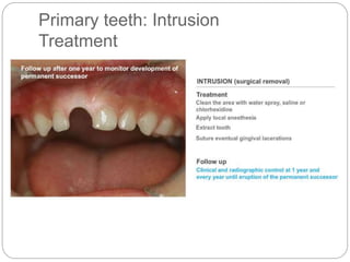 Primary teeth: Intrusion
Treatment
 