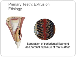 Primary Teeth: Extrusion
Etiology
 