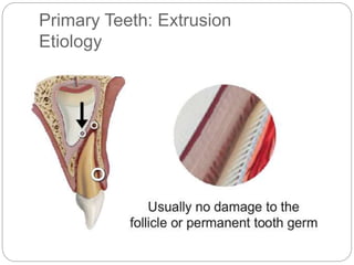 Primary Teeth: Extrusion
Etiology
 