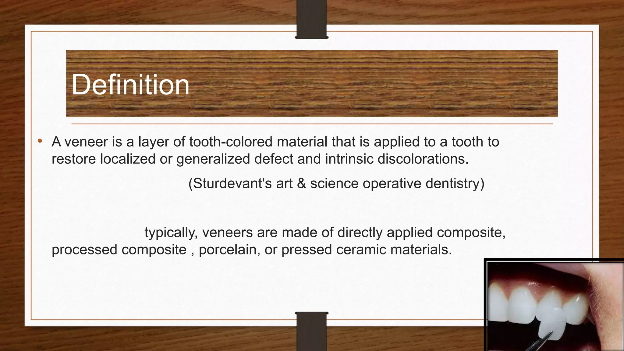Dental veneer