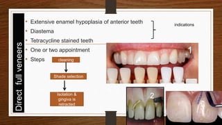 • Extensive enamel hypoplasia of anterior teeth
• Diastema
• Tetracycline stained teeth
• One or two appointment
• Steps
19
indications
cleaning
Shade selection
Isolation &
gingiva is
retracted
1
2
 