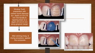 20
Window Tooth
preparation with
coarse round diamond
bur .depth is 0.5-0.75
mm mid facially &
tapering down to a
depth of 0.2-0.5 mm
along gingival margin
After etching,rinsig, &
drying procedure. applied
the composite .
3
4
5
 