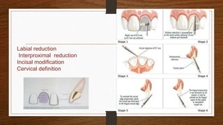 Labial reduction
Interproximal reduction
Incisal modification
Cervical definition
28
 