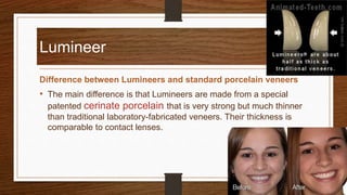 Lumineer
Difference between Lumineers and standard porcelain veneers
• The main difference is that Lumineers are made from a special
patented cerinate porcelain that is very strong but much thinner
than traditional laboratory-fabricated veneers. Their thickness is
comparable to contact lenses.
33
 