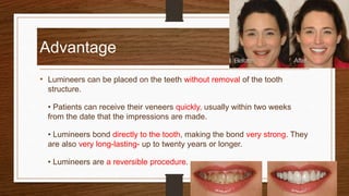 Advantage
• Lumineers can be placed on the teeth without removal of the tooth
structure.
• Patients can receive their veneers quickly, usually within two weeks
from the date that the impressions are made.
• Lumineers bond directly to the tooth, making the bond very strong. They
are also very long-lasting- up to twenty years or longer.
• Lumineers are a reversible procedure.
34
 