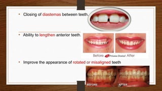 • Closing of diastemas between teeth.
• Ability to lengthen anterior teeth.
• Improve the appearance of rotated or misaligned teeth
6
 