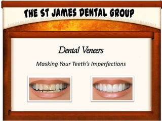 Dental Veneers
Masking Your Teeth’s Imperfections
 